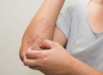Dermatitída - Konopná farma Liptov