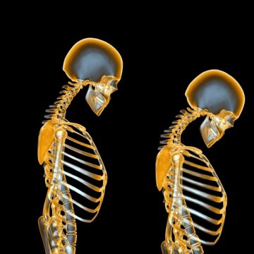 Osteoporóza - Adelle Davis
