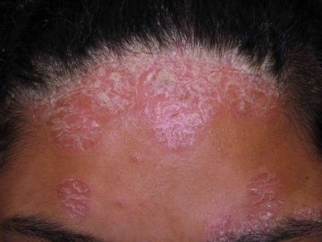 Psoriáza