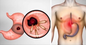 Helikobakter pylori - Masticha therapy