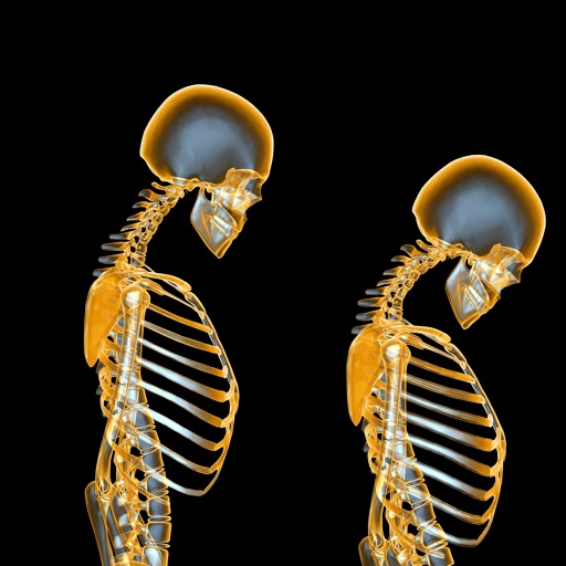 Osteoporóza - Akcia